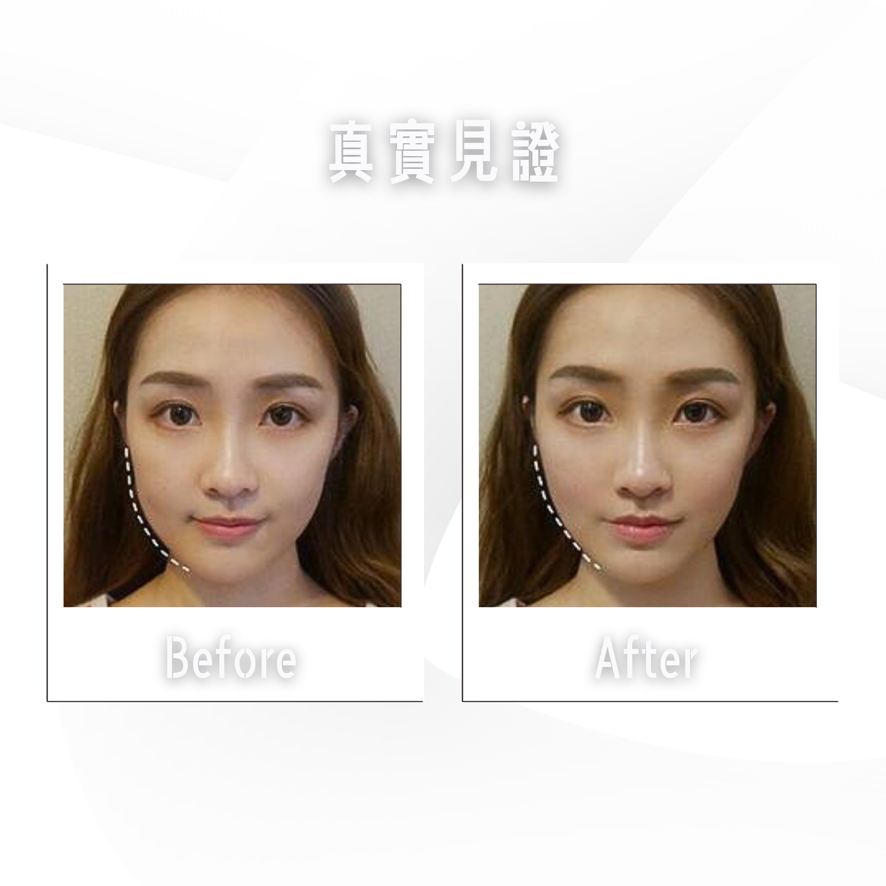 3 女性臉部前後的圖像顯示了臉部結構的差異。.